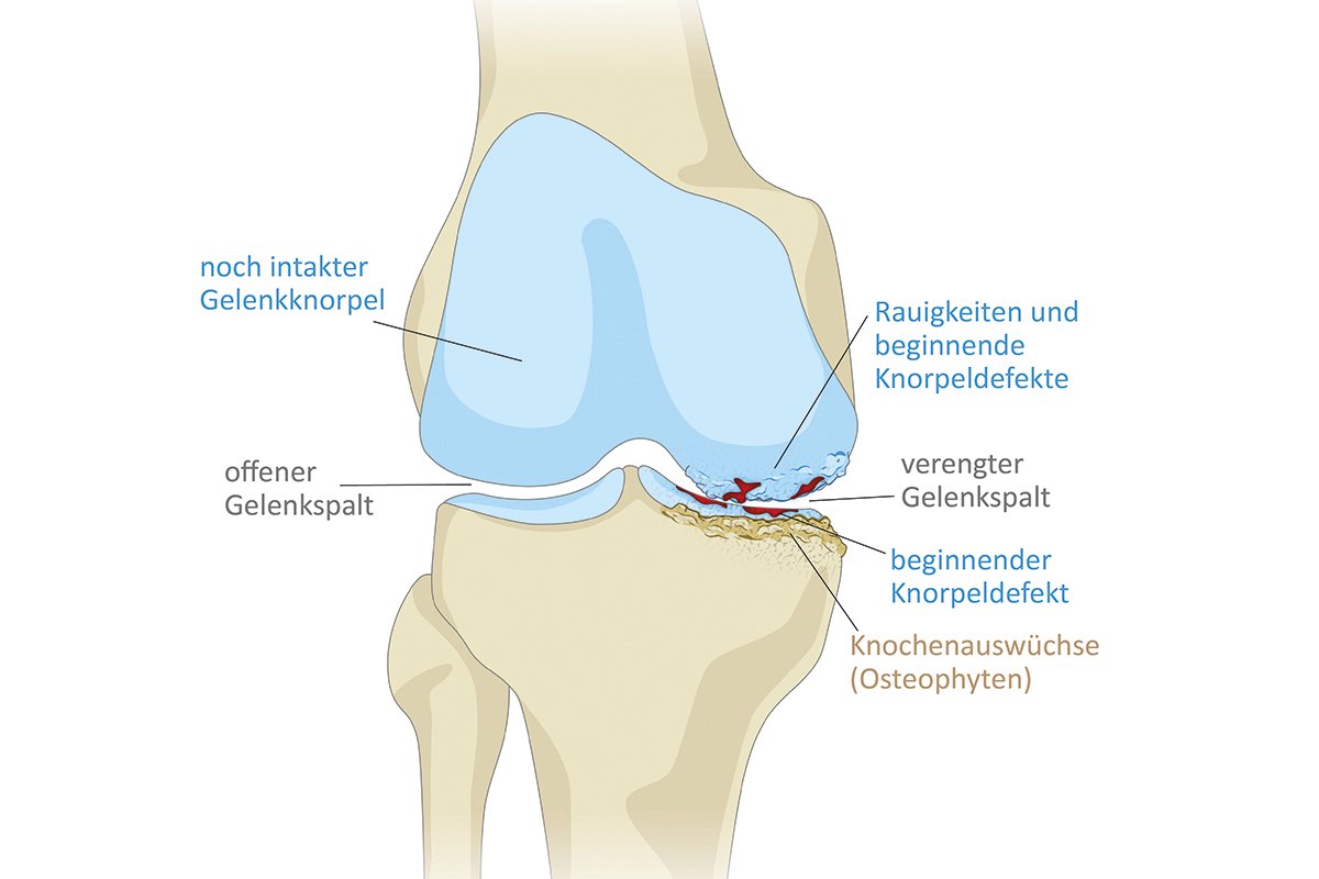 Grafik: Kniegelenk mit beginnender Gonarthrose — verengter Gelenkspalt, Knorpeldefekte und Knochenauswüchse (Osteophyten)